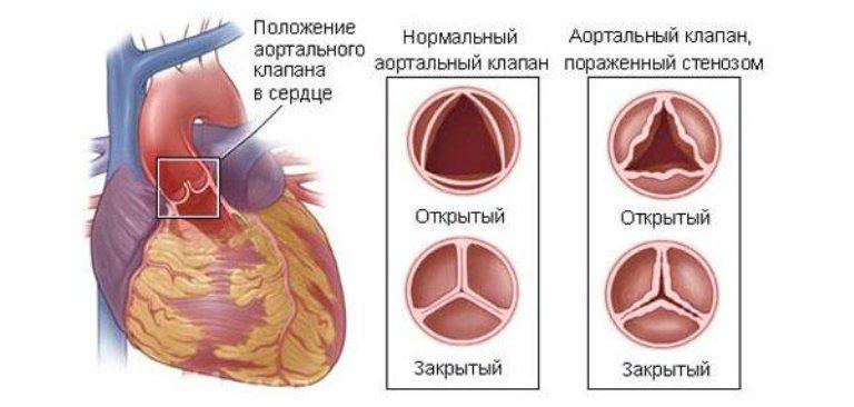 Кальциноз сердца