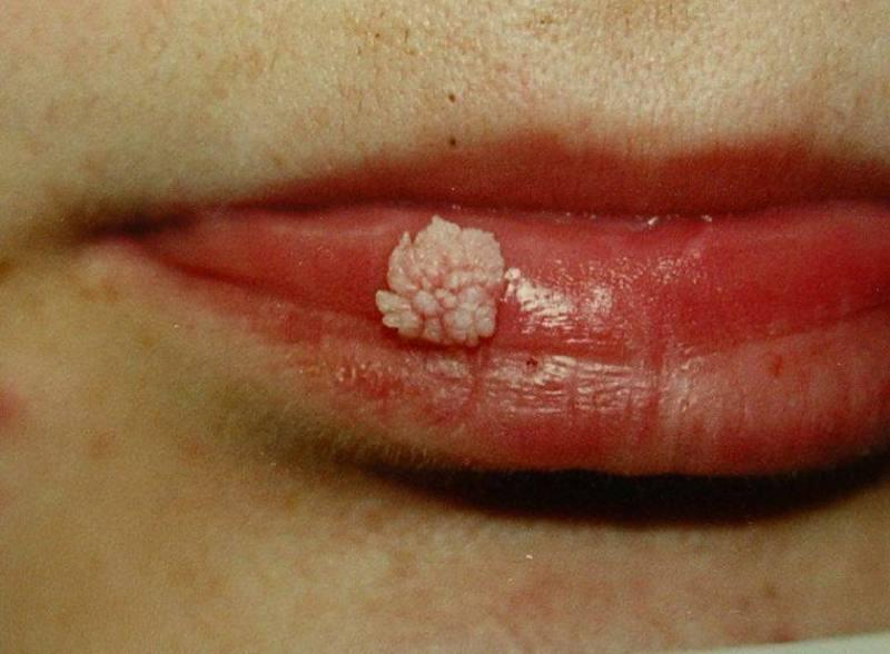 Папиллома на губе