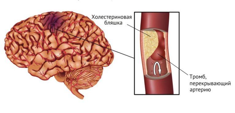 Кровоизлияние в мозг у беременных 77