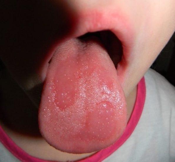 Аллергическая форма глоссита