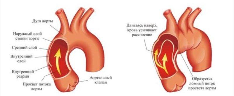 Изображение - Давление 153 на 100 для мужчин Anevrizma-aorty-