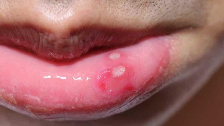 Белые пятна на губах (фото): причины и лечение