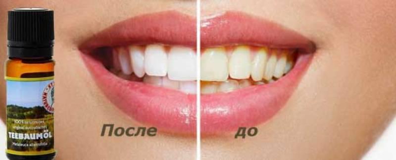 До и после применения масла чайного дерева для отбеливания зубов