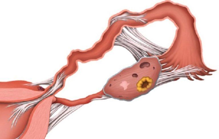 Сгустки крови при месячных: причины и фото