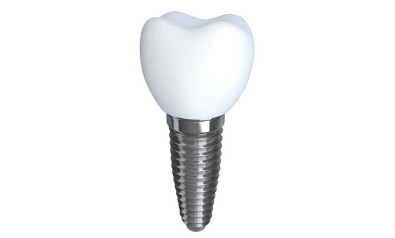 Имплантат зуба