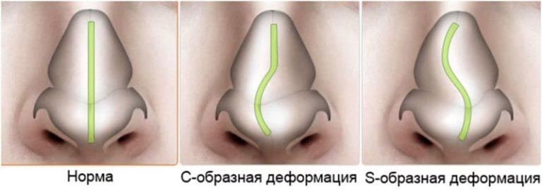 Операция по выпрямлению носовой перегородки: цена