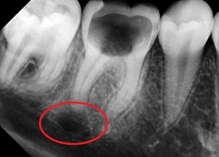 Киста зуба на рентгене