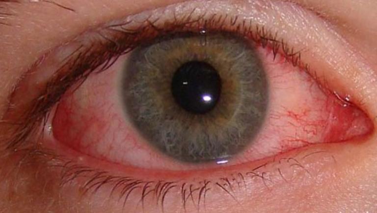 Красный глаз после сварки