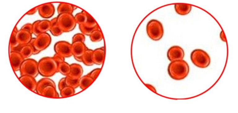 Изображение - Давление крови у детей Malokrovie-i-normal-naya-krov-