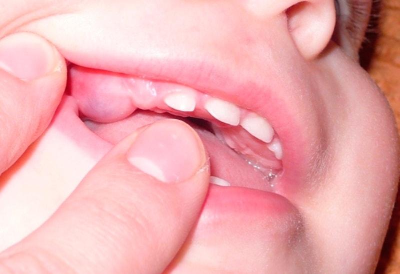 Набухшая десна из-за прорезания коренного зуба