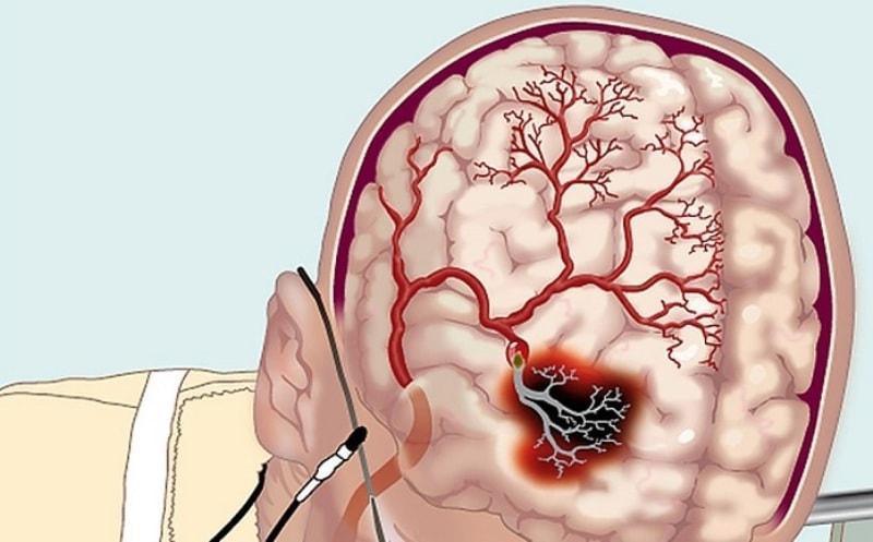 Нарушение кровообращения в головном мозге