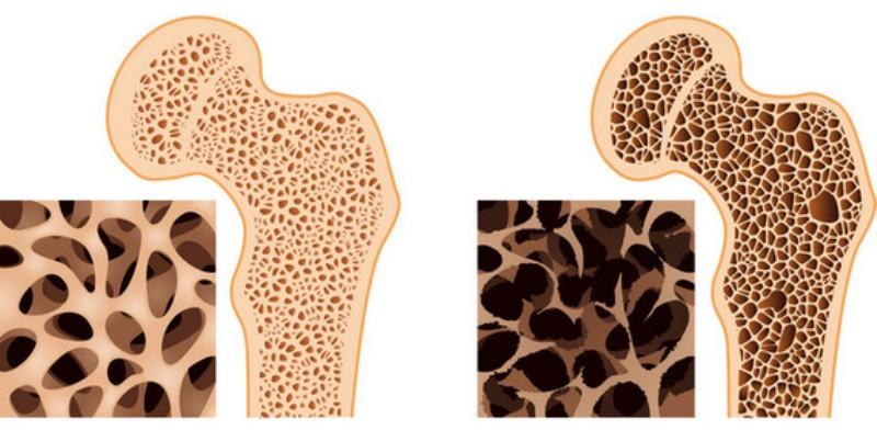 Остеопороз и нормальная кость