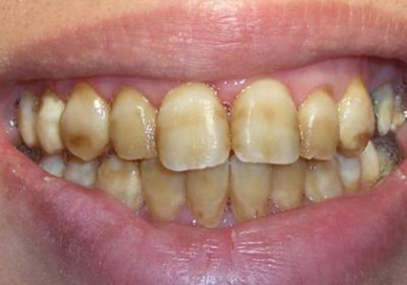 Частые полоскания рта Хлоргексидином могут вызвать потемнение эмали 