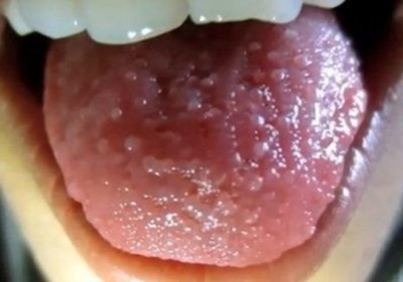 Красные прыщик на языке ближе к горлу: причины, симптомы и лечение
