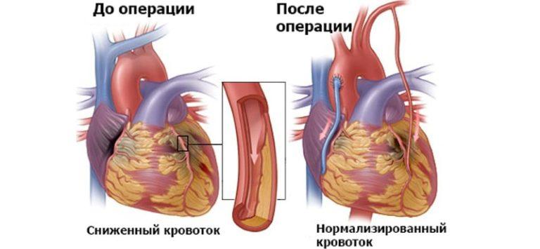 Картинки операция на сердце