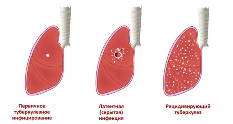 Стадии развития туберкулёза