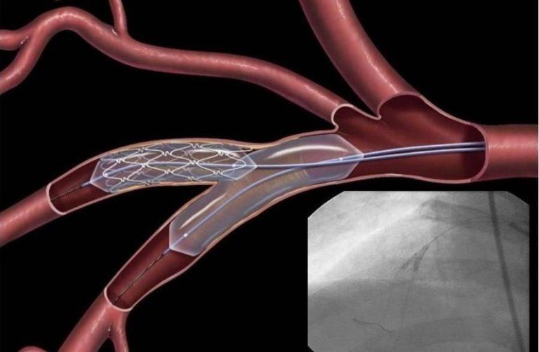 Стентирование сосудов сердца фото