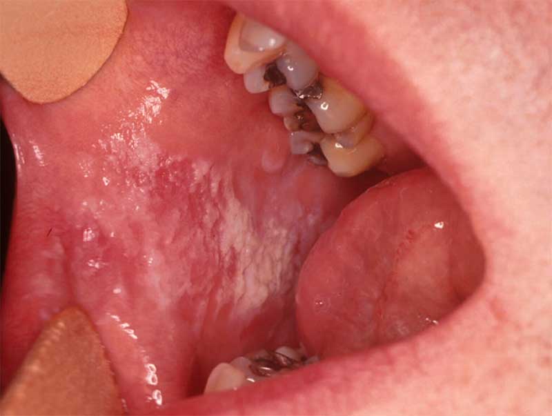 Стоматит во рту и на языке