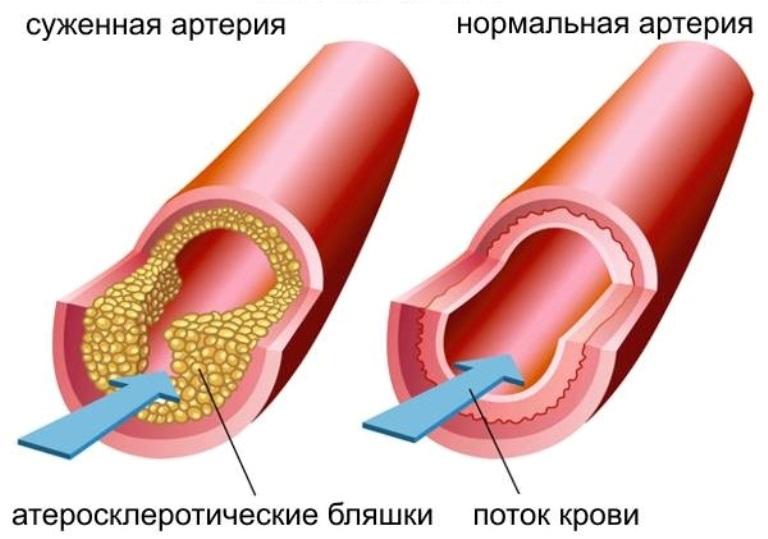 Суженная и нормальная артерия