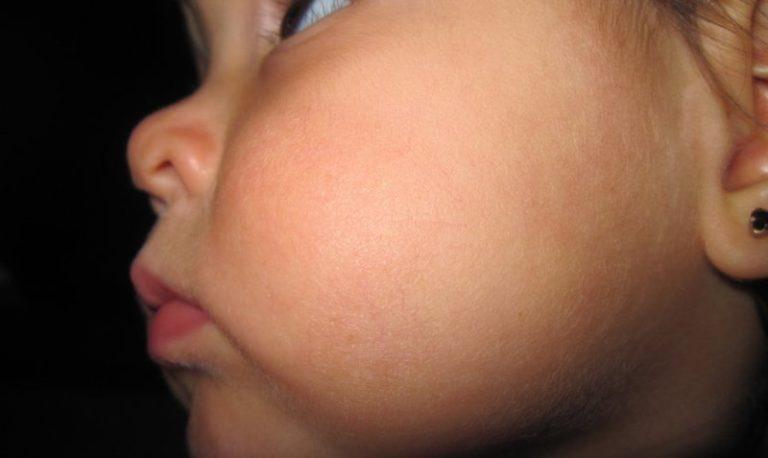 Опухшая щека у ребенка: что делать, причины