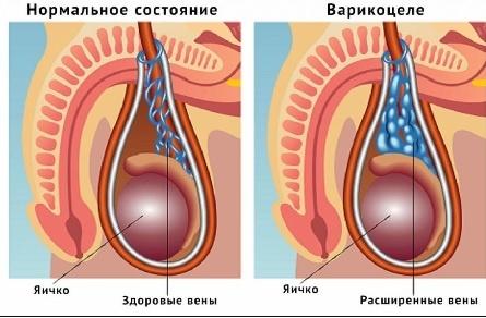 Боль в члене