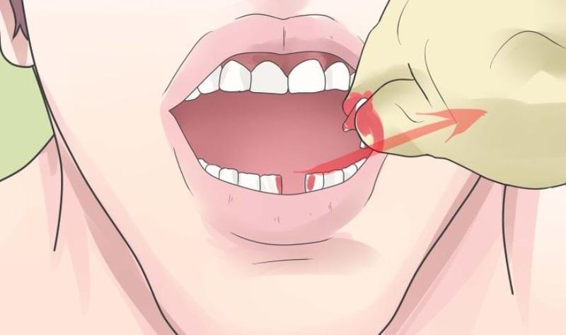 Вырывание коренного зуба самостоятельно