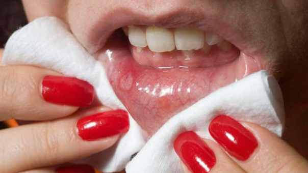 Язва в полости рта: причины и симптомы появления язвочек в полости рта, фото язв во рту