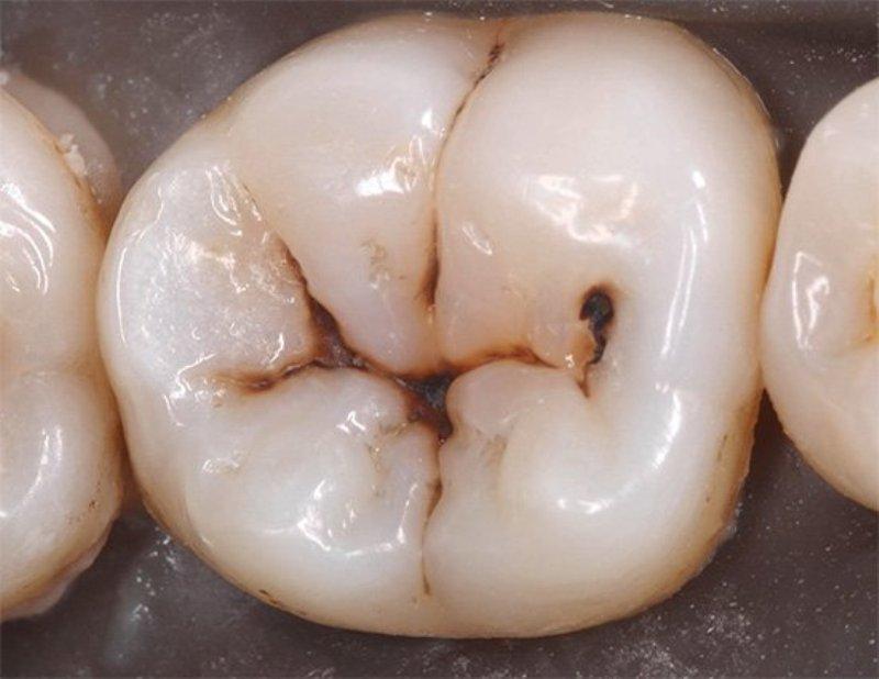 Зуб с кариесом