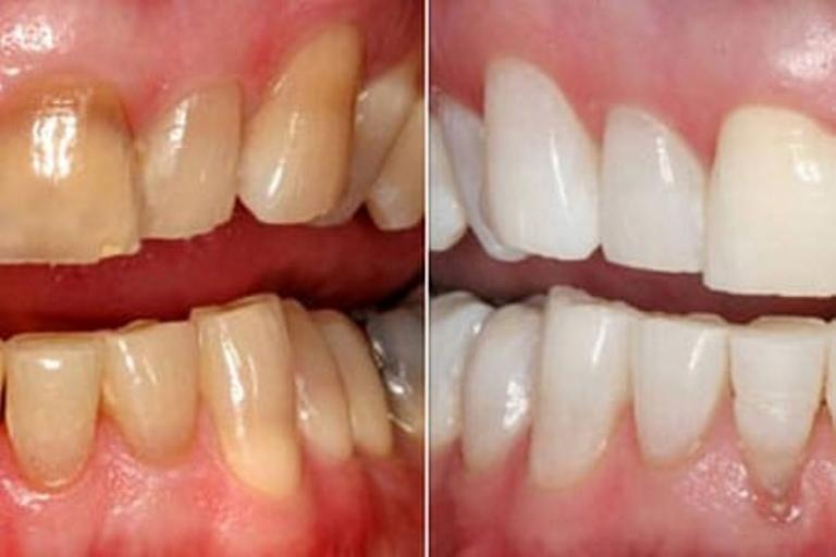 Зубы до и после отбеливания содой