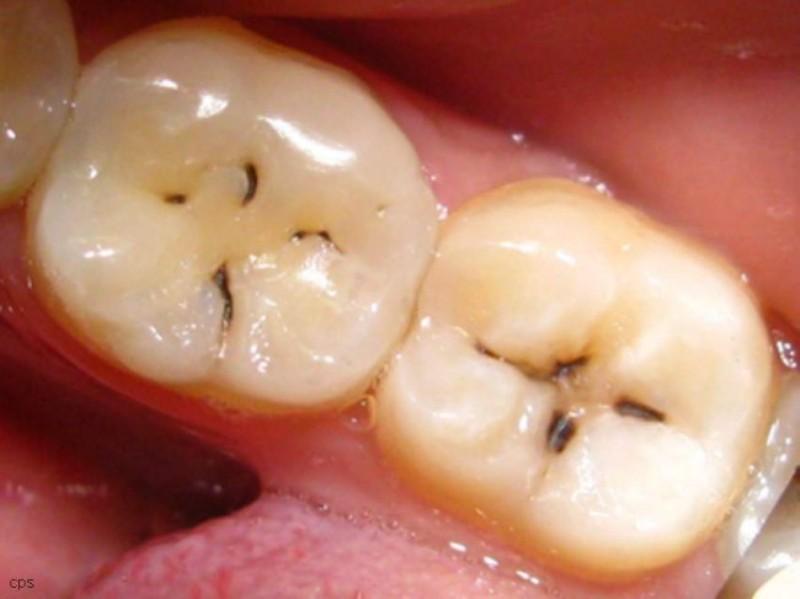Зубы с кариесом