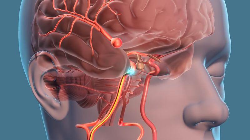 Аневризма сосудов головного мозга последствия после операции