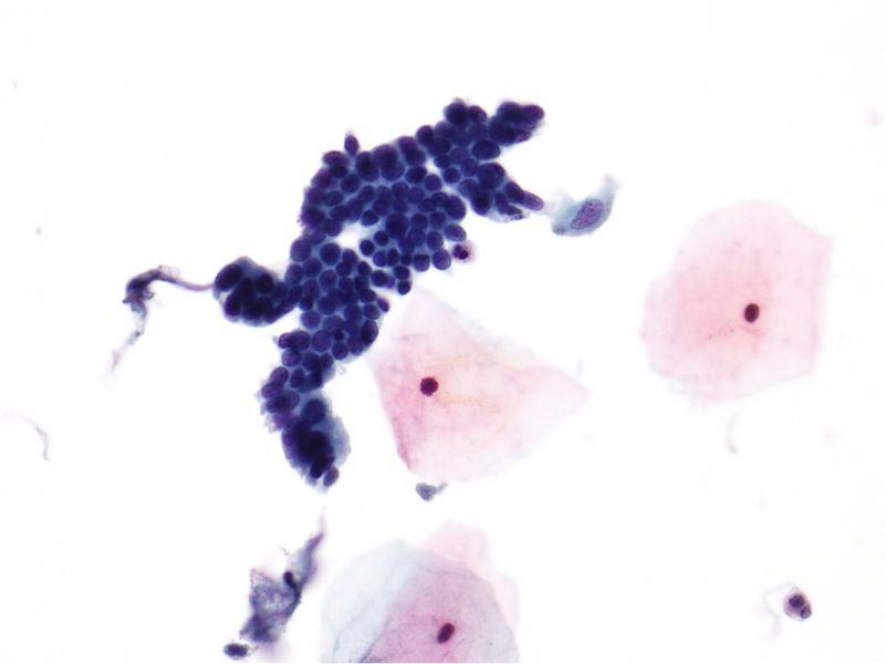 Атипичные клетки под микроскопом