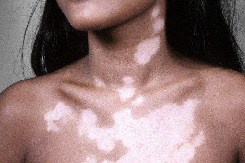 Белые пятна на коже: причины появления, лучшее лечение