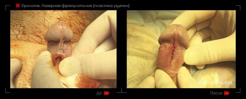 Результат до и после френулопластики