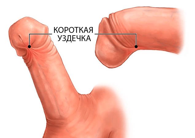 Короткая уздечка 