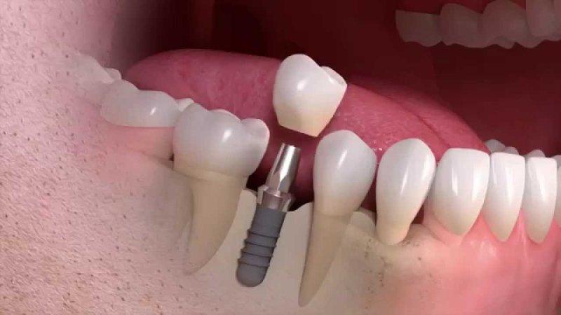 Имплантация зуба