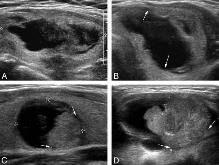 Как выглядит киста щитовидной железы на узи у женщин фото
