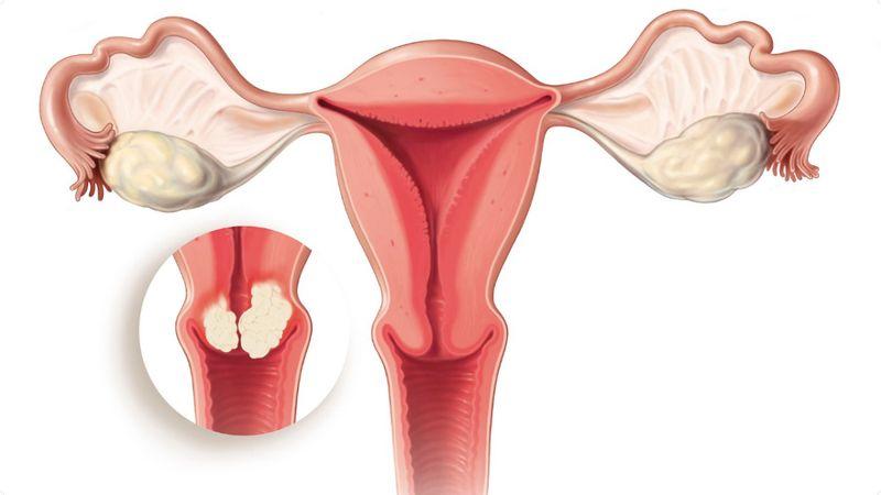Конизация шейки матки: как проходит операция, послеоперационный период