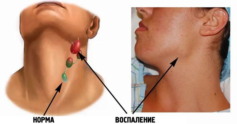 Расположение лимфоузлов на шеи фото thumbnail