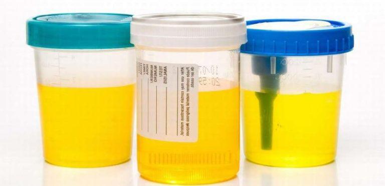 Эшерихия коли в моче: лечение, норма, симптомы и причины