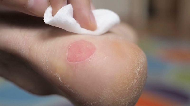 Мокнущая рана: лечение в домашних условиях – 7 фото