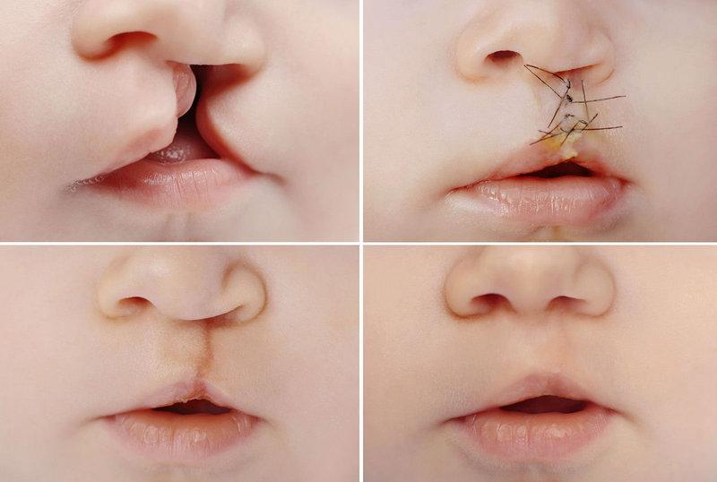 Заячья губа у малыша