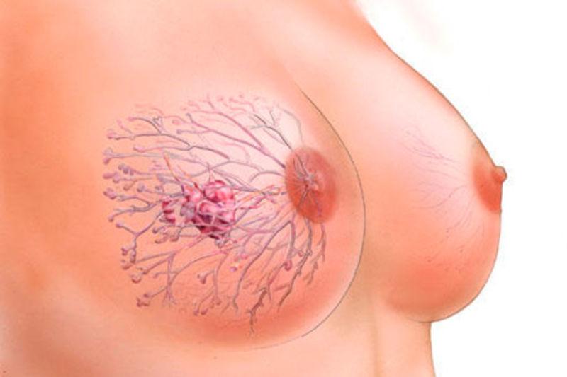 опухоль в груди у женщины