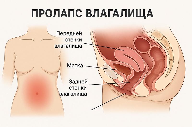 Пролапс влагалищ