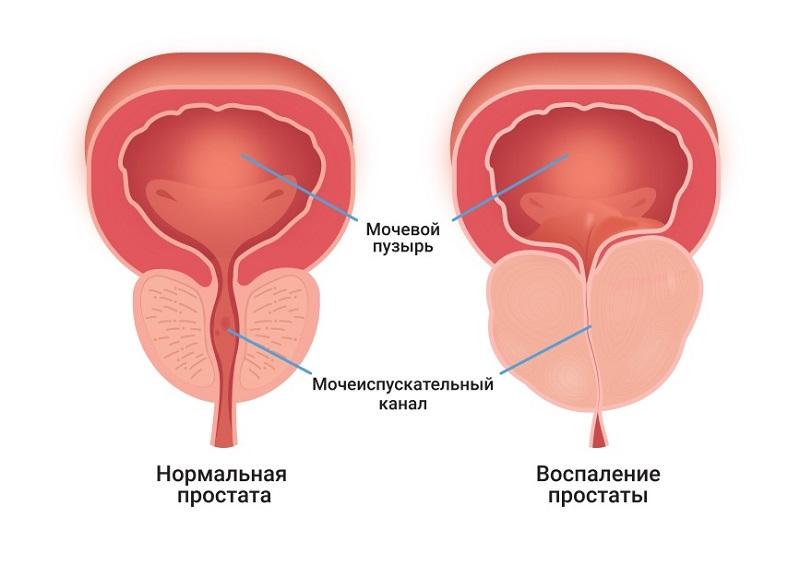Простатит