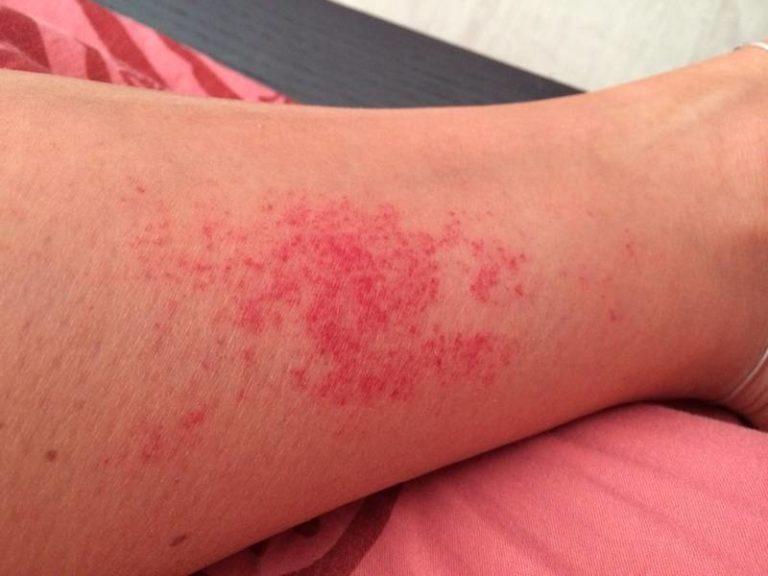 Красные пятна на ногах (фото) чем лечить и причины появления