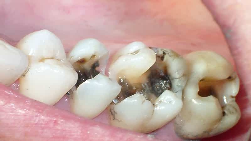 разрушение зубов