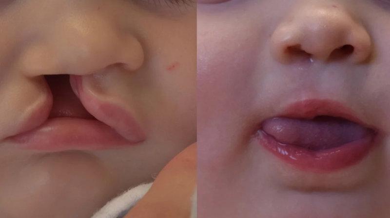 Заячья губа до и после операции