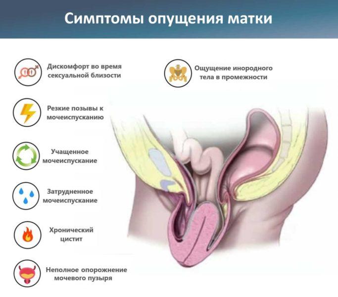 Симптомы пролапса влагалища