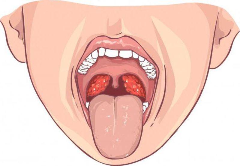 Стрептококк в горле: лечение у взрослых и детей, норма и фото